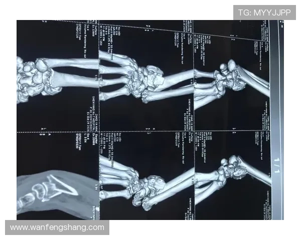 国米官方宣布迪詹纳罗右手腕骨折即将接受手术治疗